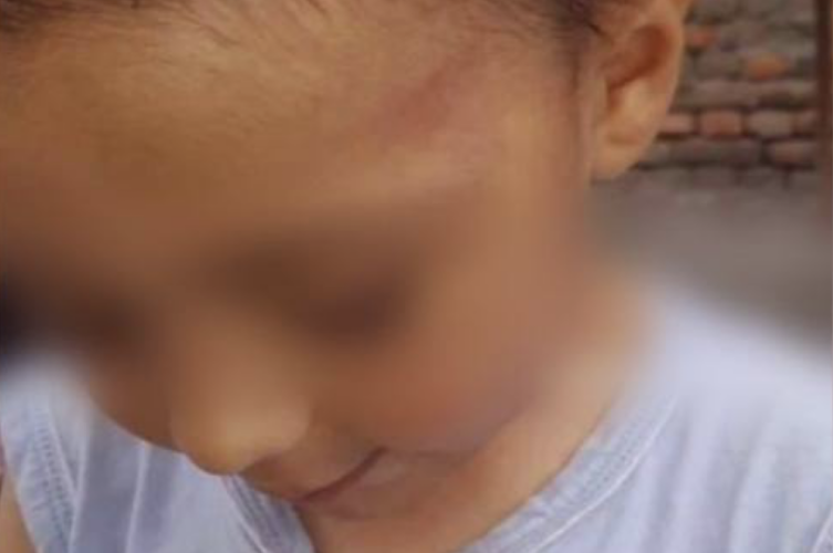 В Фергане опровергли избиение ребёнка с инвалидностью в детсаду