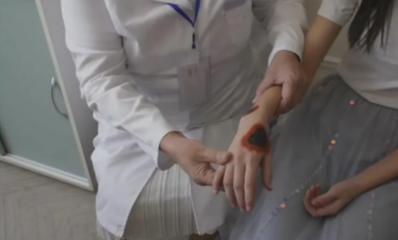 В Ташкенте подтвердили новый случай заболевания сибирской язвой